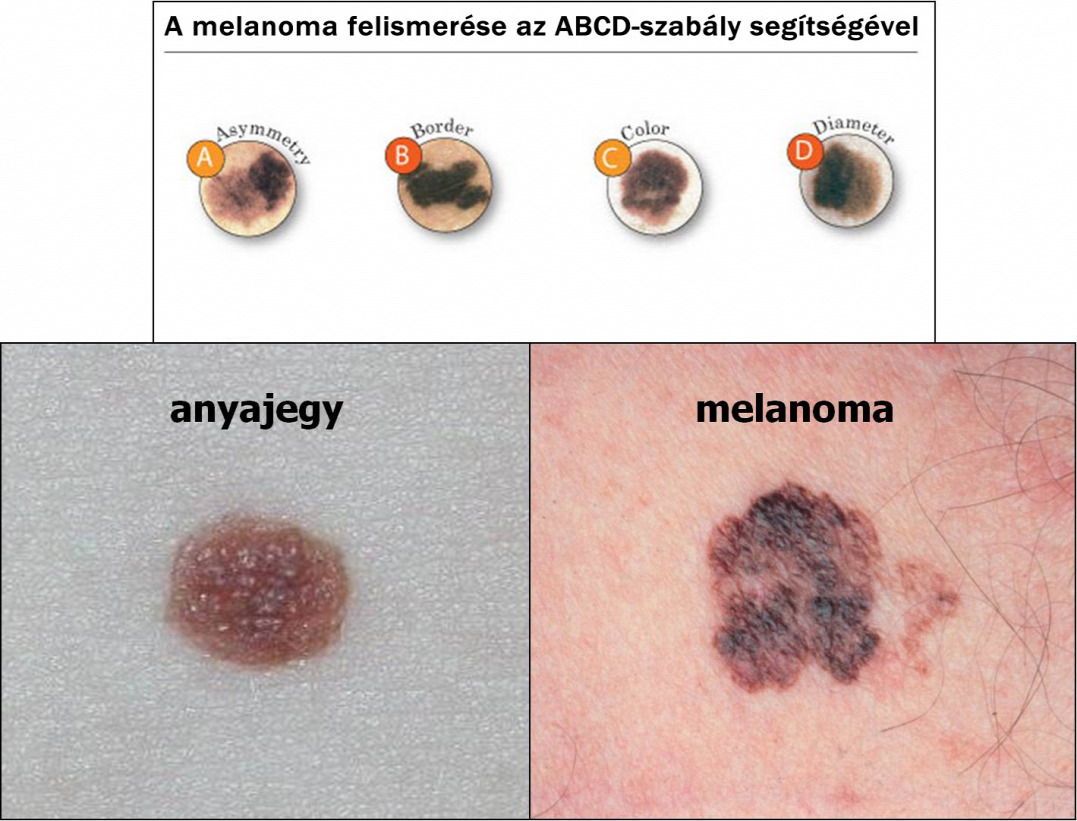 A melanoma felismerése az ABCD-szabály segítségével. Forrás: Semmelweis Egyetem