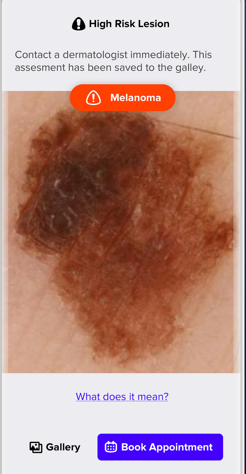 Képernyőkép az emdee Bőr alkalmazásból: A mesterséges intelligencia Rosszindulatú melanomát (melanoma malignum) detektált.